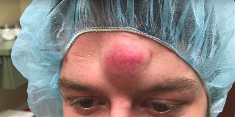 Watch Dr Pimple Popper Go To Town On This Fully Ripe 6 Year Old Unicorn Cyst