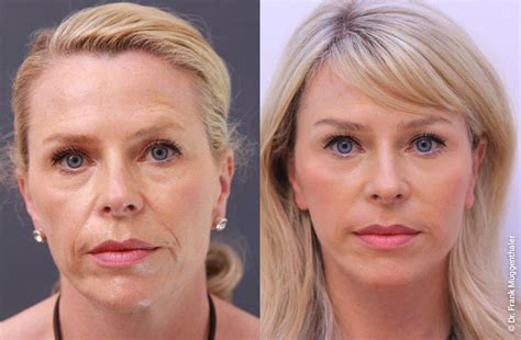 Nach der entfernung ihrer tränensäcke kann es zu schwellungen ihrer augen kommen. Vorher Nachher Bilder Facelift, Phenol Peeling ...