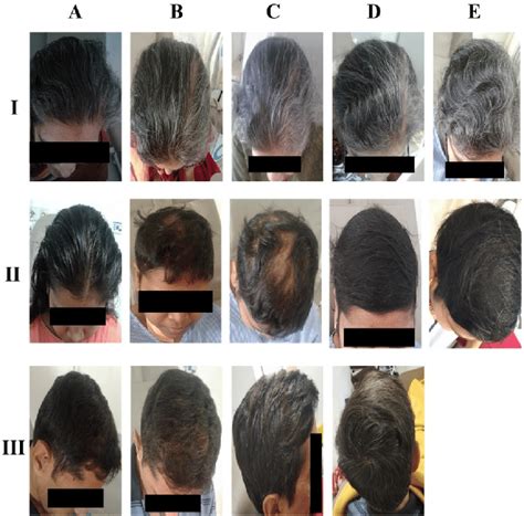 Top Image Hair Growth After Chemo Thptnganamst Edu Vn