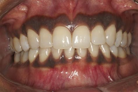 Why Some People Have Black Gums Pulselive Kenya