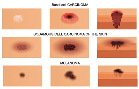 Melanoma Skin Cancer Squamous Cell Carcinoma My Xxx Hot Girl