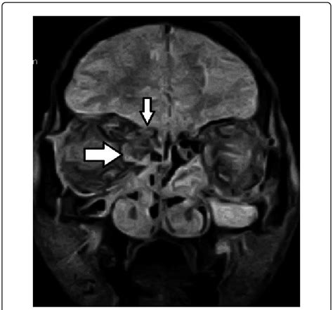 Ethmoid Roof Fracture & 68 Coronal Section Kerou0027s Type ...