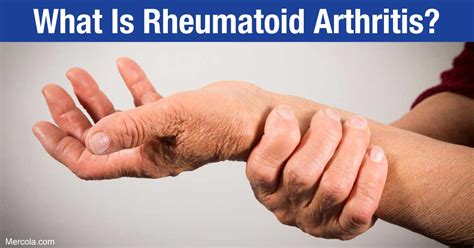 Rheumatoid arthritis (ra) is a chronic systemic inflammatory disease of unknown cause. What Is Rheumatoid Arthritis?