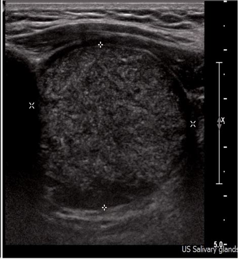 Epidermoid Cyst Ultrasound