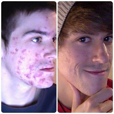 Ich würde es euch auch gerne zeigen aber ich schäme mich so sehr. Vorher - Nachher -Foto mit RENU 28 und ASEA #gesundheit # ...