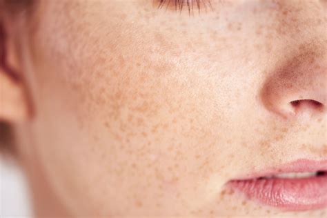 Best Supplements For Melasma Vitasave