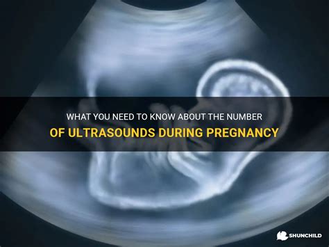 What You Need To Know About The Number Of Ultrasounds During Pregnancy