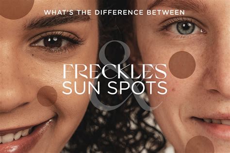 The Difference Between Freckles And Sun Spots Dr Natasha Cook Dr