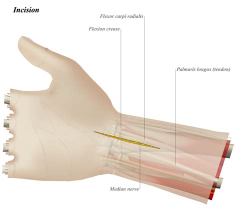 Volar Approach To Wrist Approaches Orthobullets