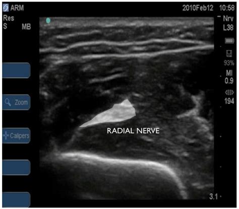 Ultrasound Guided Local Anaesthetic Blocks Of The Forearm Anaesthesia