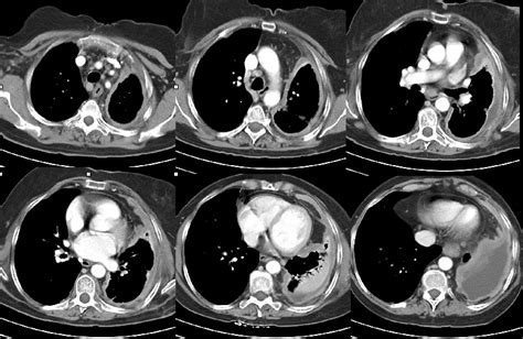 Mesothelioma Ct Scan Images Abdominal Ct Scan Find Out How A Ct