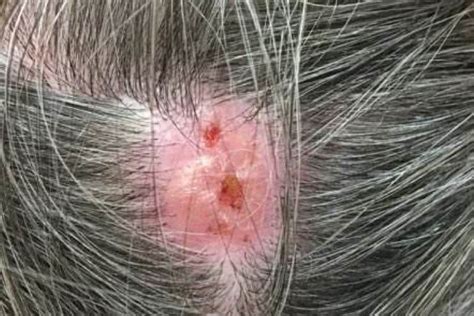 Scalp Lesion Causes Treatments Remedies And Hair Loss Strong Hair