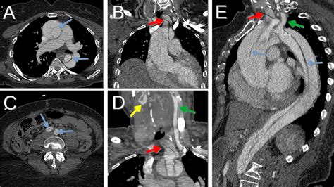 Stanford A Aortic Dissection