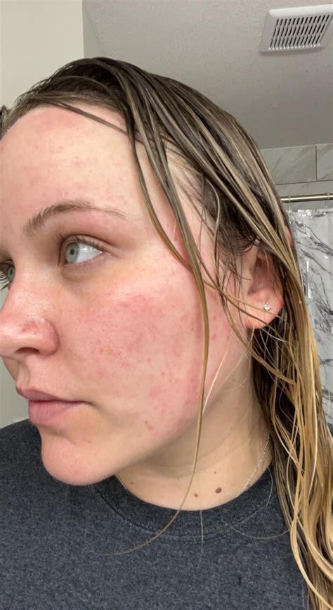 Redness And Splotches After Showering Rskincareaddiction