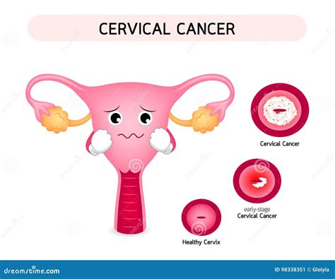 [diagram] iud cervix diagram mydiagram online