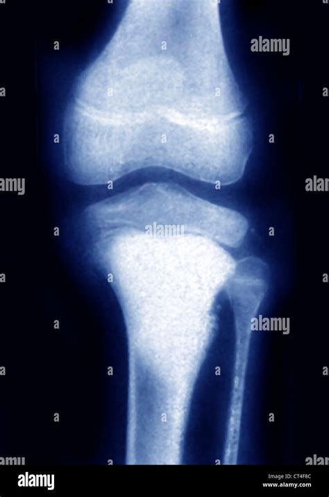 Osteosarcoma Knee Hi Res Stock Photography And Images Alamy