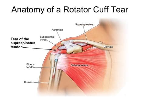 The shoulder joint (glenohumeral joint) is a ball and socket joint between the scapula and the humerus. Understanding Rotator Cuff Injuries - Movement Solutions ...