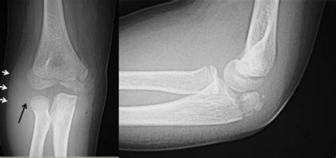 Anteroposterior And Lateral Radiographs Of The Elbow Open I