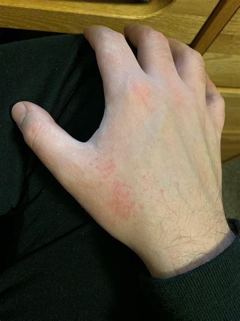 These Red Spots Randomly Appear On My Hand They Are Not Raised And
