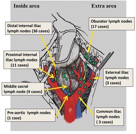 Internal Iliac Lymph Nodes