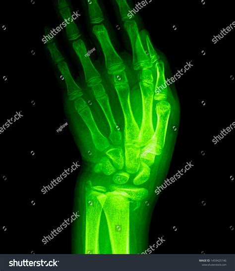 Wrist X Ray Anatomy Radiology Radiographic Stock Photo 1459425146