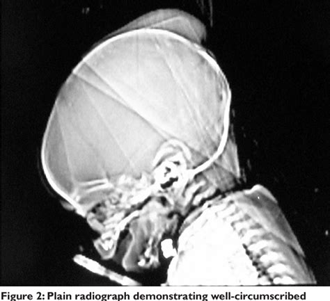 Pdf Delayed Sub Aponeurotic Fluid Collections In Infancy Three Cases