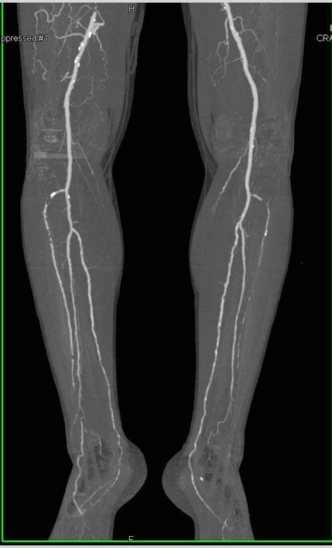 Cta Runoff With Occlusion Of The Right Superficial Femoral Artery Sfa