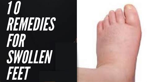 Swelling Feet Remedies Foot Remedies Natural Remedies Health Guru