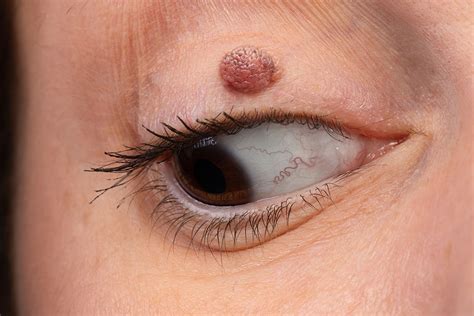 Eyelid Skin Lesions The Importance Of An Early Check Up Specialist