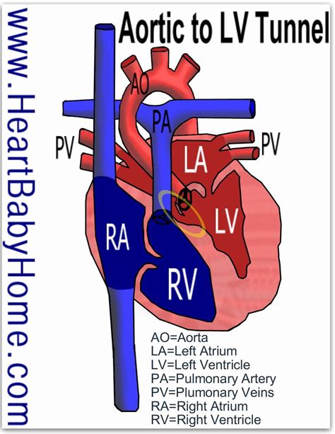 Pin By Nonas Arc On Aorto Ventricular Tunnel Incl Left And Right
