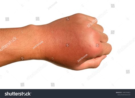 Inflammation Swelling Redness Hand Shows Infection Stock Photo