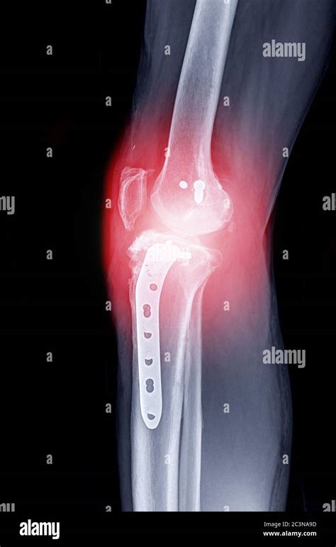 X Ray Image Of Right Knee Lateral View Showing Total Knee Arthroplasty