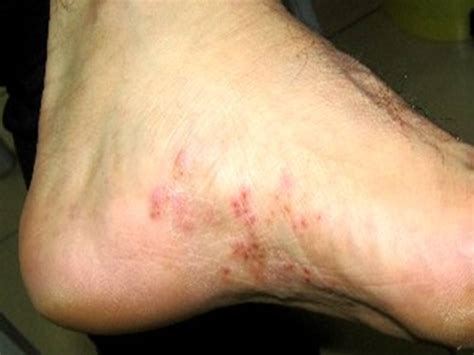 Tinea Pedis Athletes Foot Causes Symptoms Treatment Images