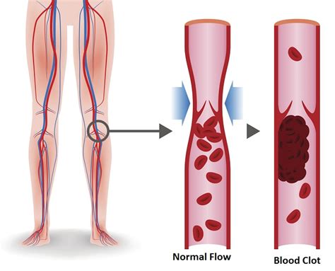 Signs And Symptoms Of A Blood Clot Health Beat