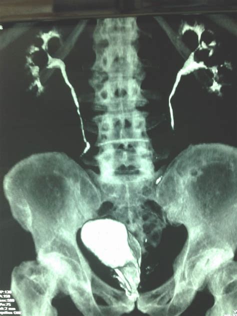 Vietnamese Medic Ultrasound Case 402 Double Urinary Bladder Dr Phan