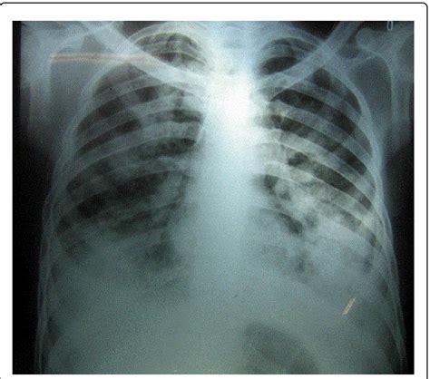 Chest Radiograph Showing Extensive Bilateral Infiltrates Due To