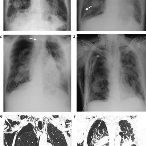 Mesothelioma In A 57 Year Old Patient With Asbestosis A Diffuse