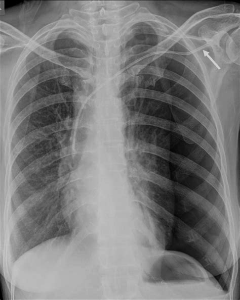 Frontal Chest Radiograph Shows A Left Sided Pneumothorax Following