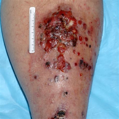 Here is an image of what melanoma looks like. Skin Cancer Images: Types of Skin Cancer | SkinCancer.net
