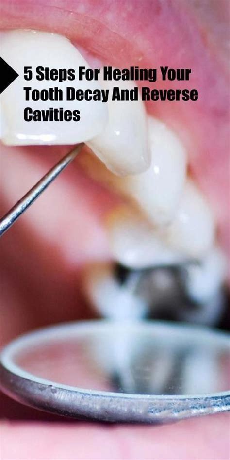 Dental caries is the softening of your tooth enamel and describes the damage of the structure of the tooth triggered by acids that are created when plaque bacteria break down sugar in your mouth. 9 Steps For Healing Your Tooth Decay And Reverse Cavities ...