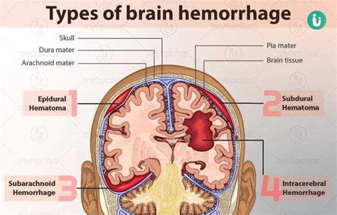 Brain Hemorrhage Symptoms Causes Treatment Medicine Prevention