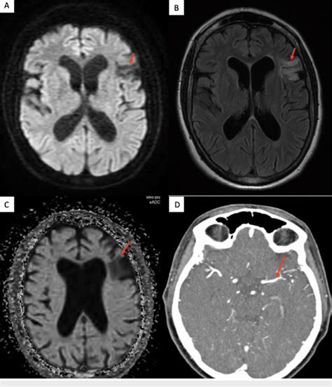 Mri Of The Brain Showing A A Hypo Intense Signal In The Left Frontal