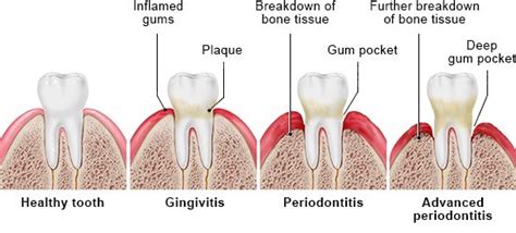 Gingivitis And Periodontitis Overview Ncbi