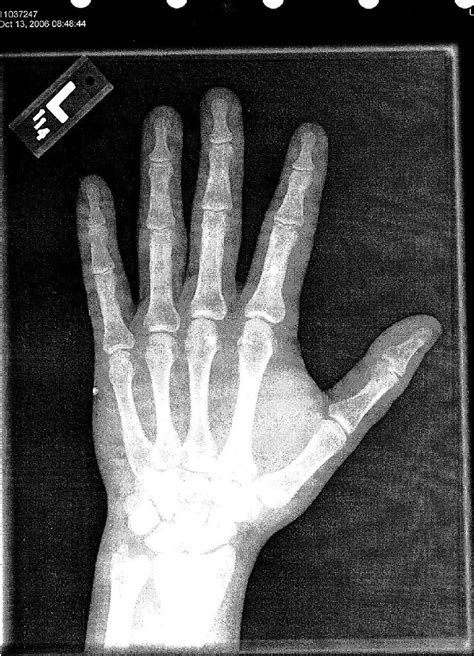 Wrist X Ray Broken Left Wrist And Pinky Sanhelsington