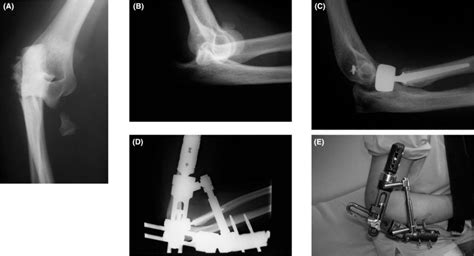Terrible Triad Of The Elbow Treatment Protocol And Outcome In A Series