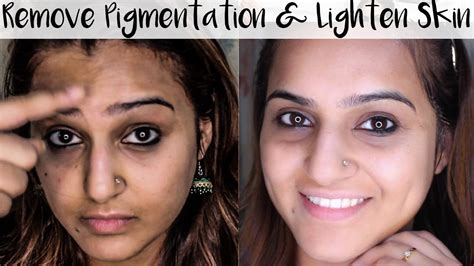 How To Get Rid Of Skin Pigmentation Around Eyes