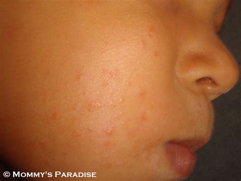 Eczema Pimple Like Bumps Dorothee Padraig South West