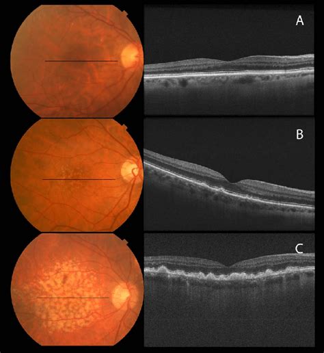 Representative Color Fundus Photographs And Octs Corresponding To