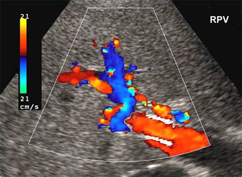 Online Cme Sonography Of Tips Sonography Ultrasound Vascular