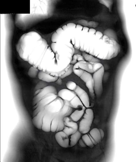 Polyp In Tortuous Descending Colon Which Is On A Stalk Colon Case